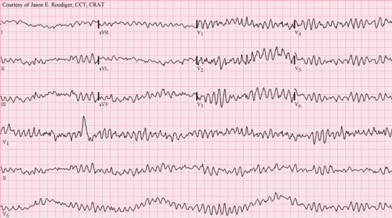 EKG of ventricular fibrillation