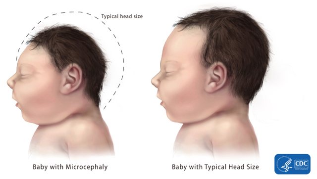 A head size comparison of a normal baby and a baby born with microcephaly. Image provided by Public Health Insider.