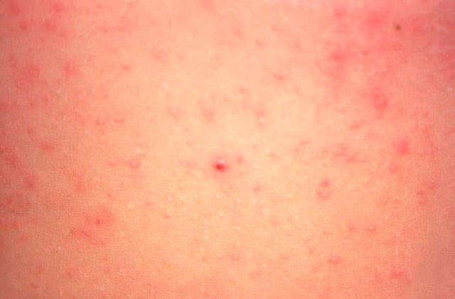 Measles can cause a rash as late as three to five days after exposure to the virus. Image courtesy the Tacoma-Pierce County Health Department