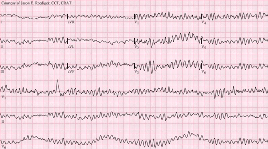 EKG of ventricular fibrillation