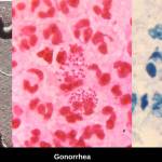 A tale of three STIs | Public Health Insider