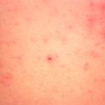 Measles can cause a rash as late as three to five days after exposure to the virus. Image courtesy the Tacoma-Pierce County Health Department