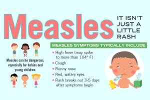 Auburn, Kent exposed to measles